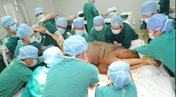 cea mai mare tumora din lume extirpata in 16 ore cantarea 110 kilograme