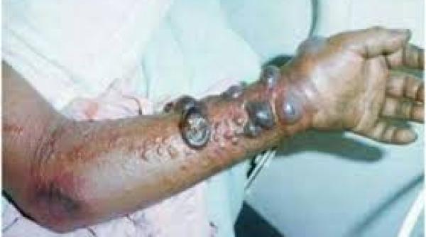 virusul ebola ajunge joi in europa oms vrea sa declare stare de urgen a