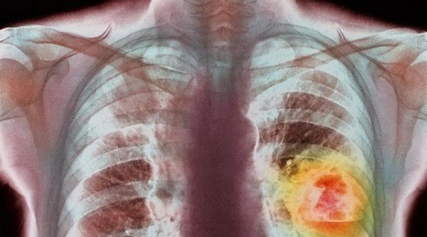 cancer pulmonar doua grupuri farmaceutice s au aliat pentru a testa un medicament