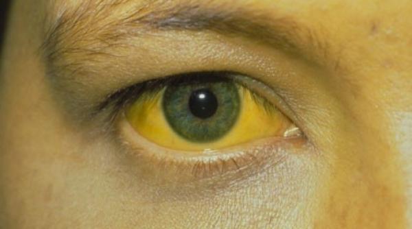 nou focar de hepatita a confirmat in vaslui