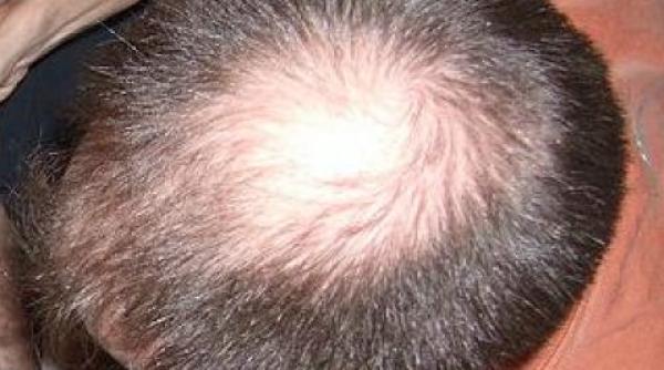 tratament calvi ie dezvoltat cu ajutorul leucocitelor studiu