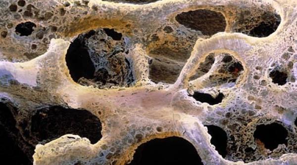 cancer osos simptome cate tipuri de cancer osos exista