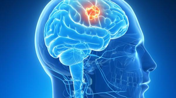 cancer cerebral simptome provocate de tumorile cerebrale