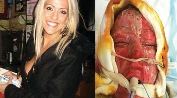 dana vulin desfigurata de arsuri cum arata dupa doi ani