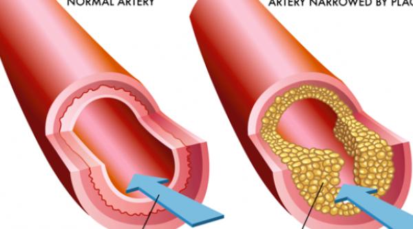 colesterol marit ivezi ce trebuie sa mananci