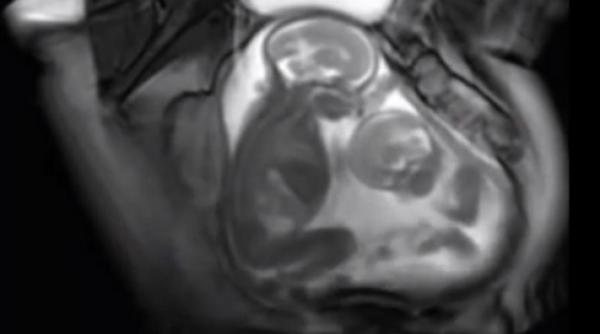 imagini senza ionale doi gemeni se bat in pantecul mamei video