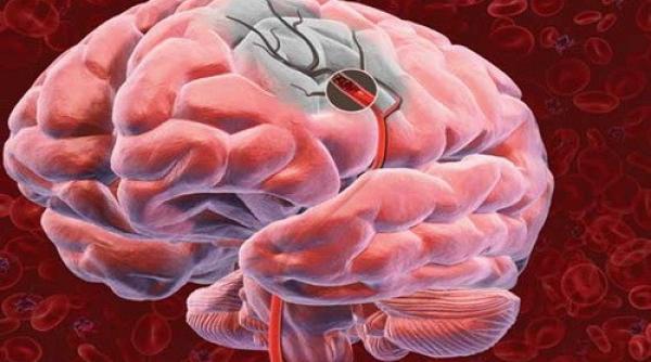 ce vitamina previne accidentul vascular cerebral