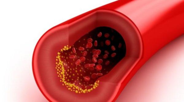 colesterolul depus pe artere poate fi dizolvat cu cateva alimente