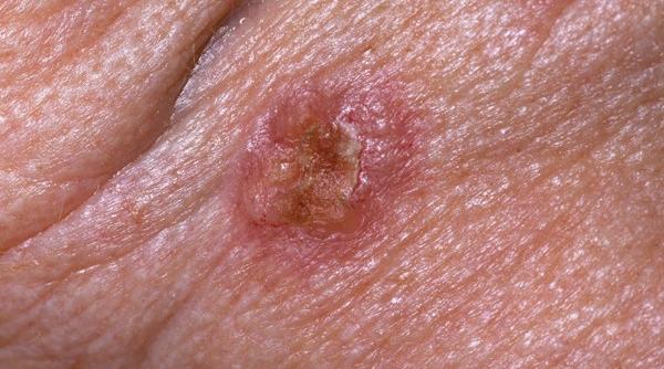 nou tratament pentru cancerul de piele autorizat de comisia europeana odomzo