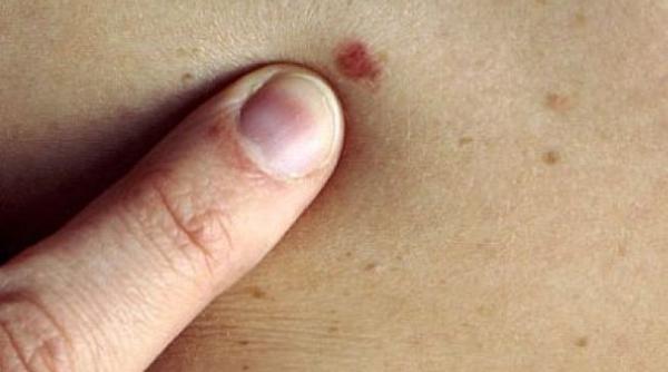 cancer de piele medicament aprobat in procedura accelerata in marea britanie