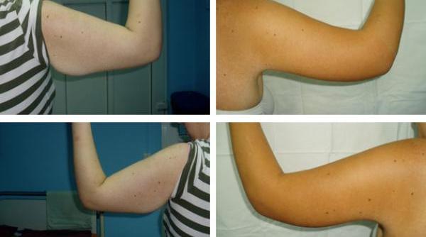 legatura dintre numarul de aluni e de pe bra i apari ia cancerului