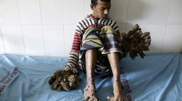 omul copac a fost operat