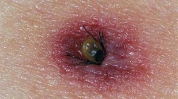 dsp sibiu alerta epidemiologica in privinta bolii lyme