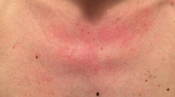 de ce iti apar pete rosii pe piept dupa ce faci dus