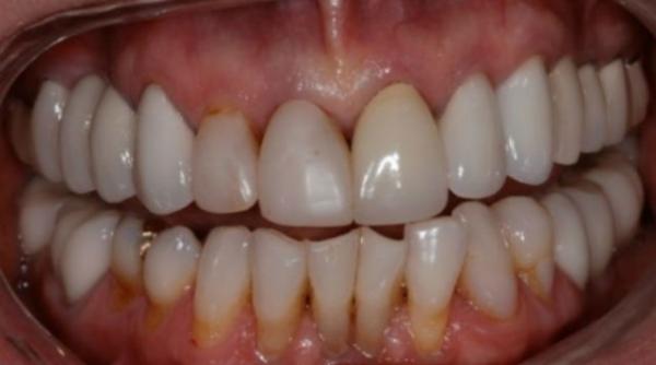 parodontoza ce este i cum o tratezi