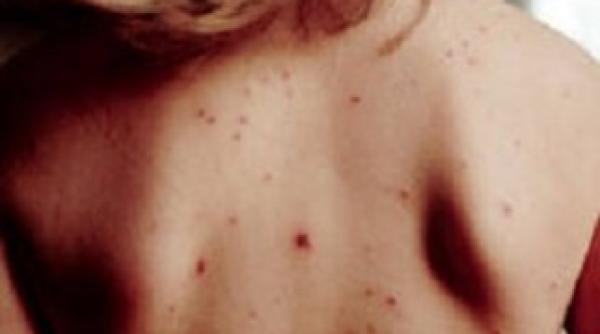 al i doi copii deceda i din cauza rujeolei