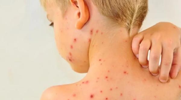 epidemie rujeola numarul deceselor in cre tere