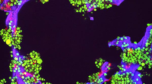 mielom multiplu nou tratament inovator compensat