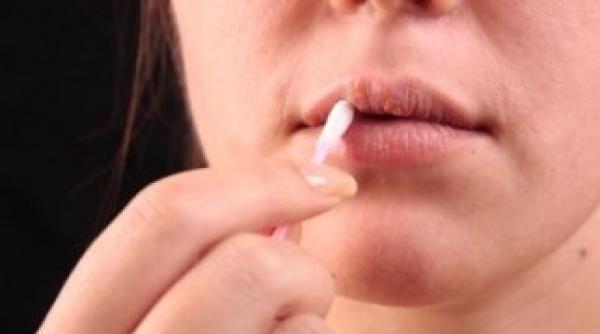 herpes tratament vindecare rapida