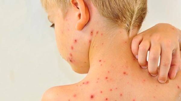 epidemie rujeola peste o suta de noi cazuri in ultima saptamana