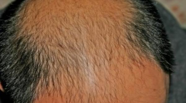 leacul impotriva cheliei gasit de cercetatorii japonezi tratament revolu ionar