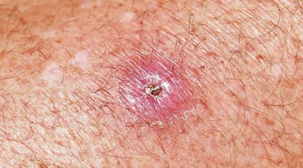 ulcerul buruli se raspande te cu repeziciune in australia