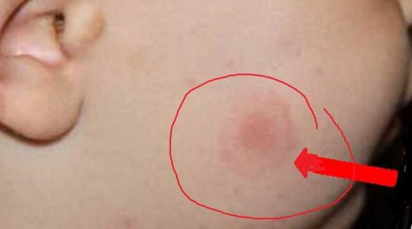 lyme boala de sezon daca ai astfel de pete pe piele mergi la spital