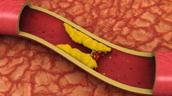 microbiomul intestinal sanatatea arterelor trece prin intestin