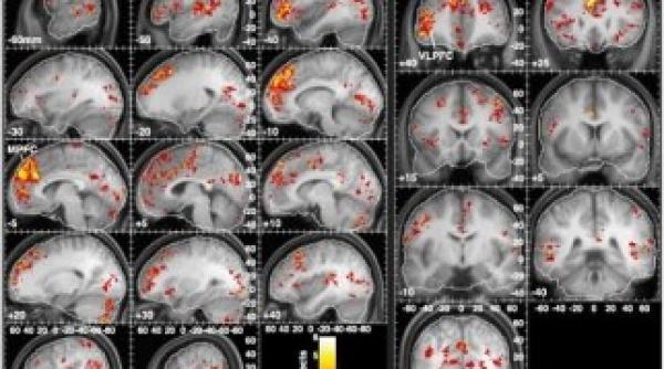 premiera mondiala celule stem injectate in creierul pacien ilor cu boala parkinson