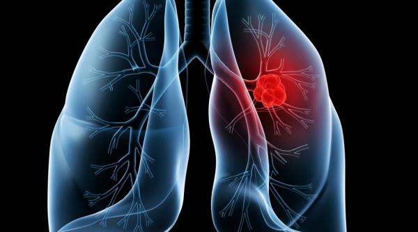 cancerul pulmonar diagnostic i terapii inovative