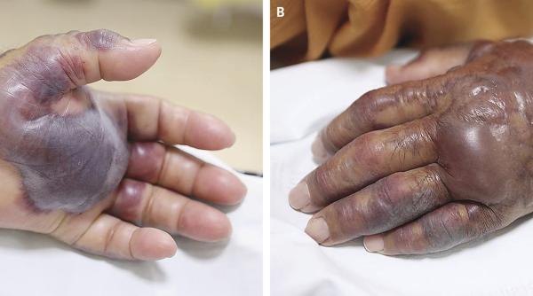 caz ocant a suferit amputarea bra ului dupa ce a mancat fructe de mare crude