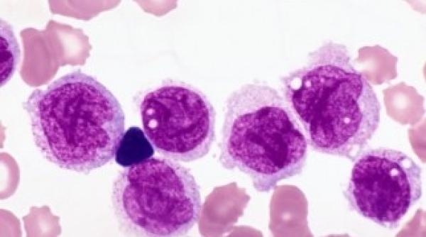 prof dr daniel coriu interviu leucemia tratata cu molecule inteligente