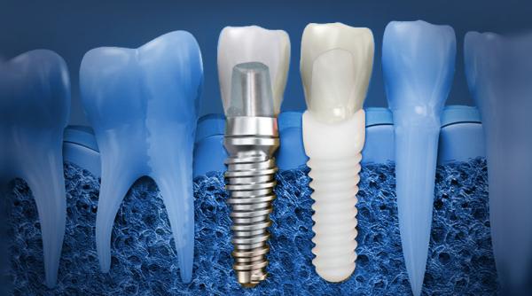 implantul dentar complet din ceramica