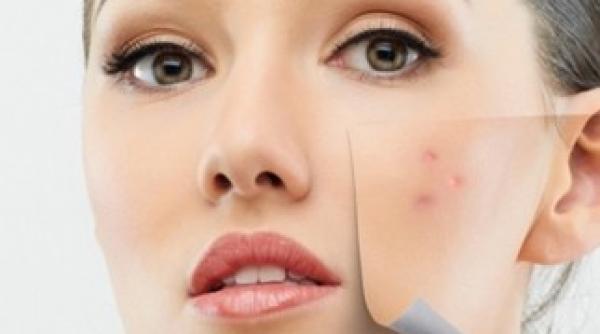 primul vaccin contra acneei inova ia care aduce fericire pe chipul adolescen ilor