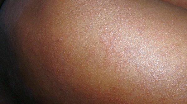 bilan ul epidemiei de rujeola 82 de cazuri noi intr o saptamana