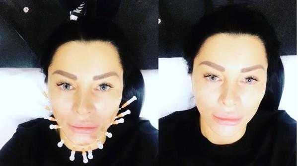 brigitte nastase interventie neobisnuita 100 de fire introduse in fata cu acul