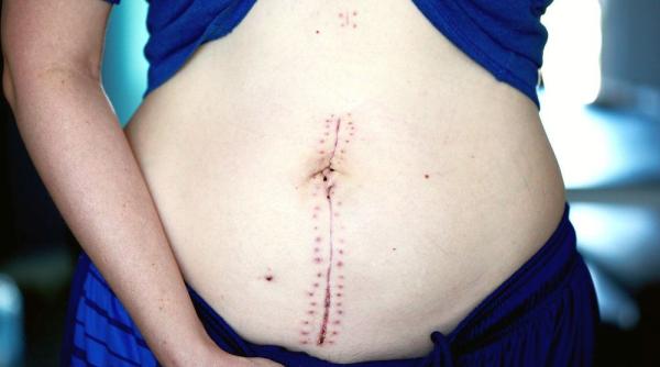 operatii de slabit ce riscuri au interventiile din chirurgia bariatrica