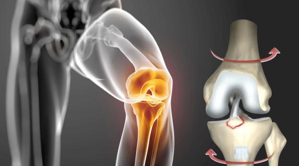 rupturi de ligamente la genunchi tratamente moderne dr liviu ojoga explica