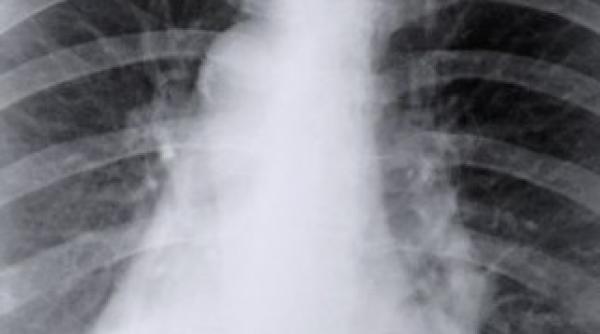 trei cazuri de tuberculoza la o scoala din braila