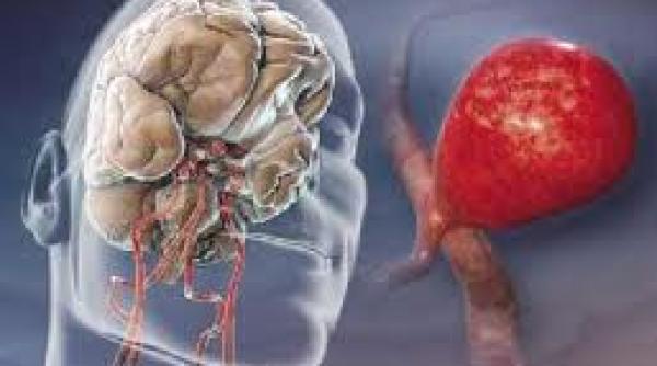 anevrismul moarte subita la tineri sanatosi dr mihalea cum poate fi tratat