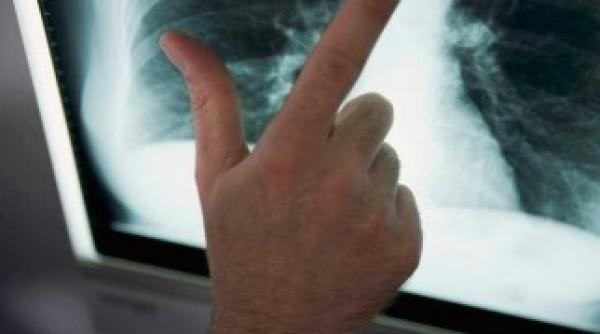 cancerul la plamani este responsabil pentru moartea a 20prc dintre romani