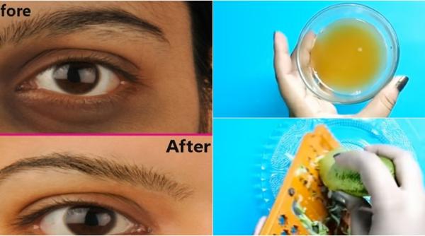 cum scapi de cearcane in 3 zile truc simplu si ieftin a functionat la milioane de femei