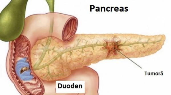 cancer pancreatic medicamentele care ar creste rata de supravietuire