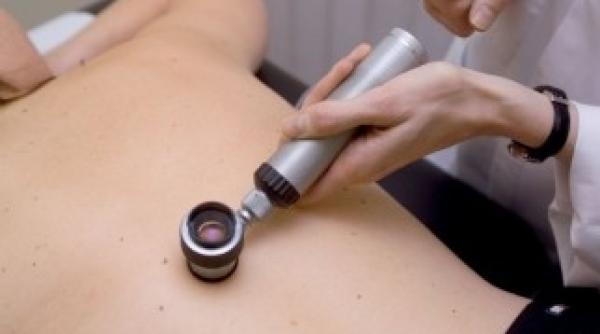 campanie de informare educatie si depistare a cancerului de piele la targu mures