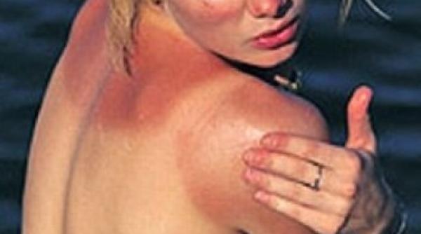 remedii naturale pentru combaterea arsurilor solare