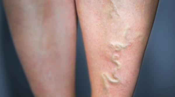 elimina varicele cu usturoi si portocala