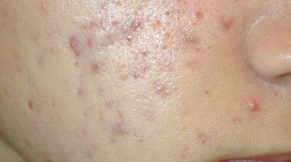 leacul care te scapa de acnee ai nevoie doar de doua ingrediente simple