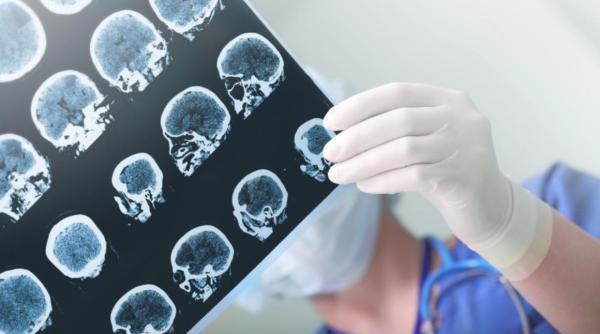 accidentul vascular cerebral simona brana despre tratament si costuri harta este putin infricosatoare