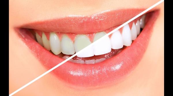 dinti mai albi in doar doua minute cum faci asta acasa cu doua ingrediente ieftine