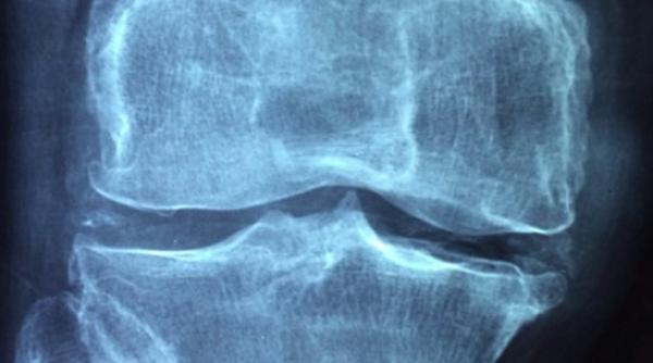 china medicament pentru artrita folosit pentru a trata coronavirusul